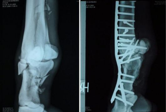 Progress made in treating fractures in horses. 1 radiografia 2